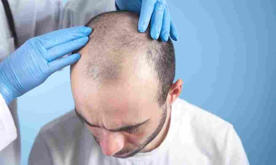 Hair Transplant Turkey: Get a Natural Hairline Transformation