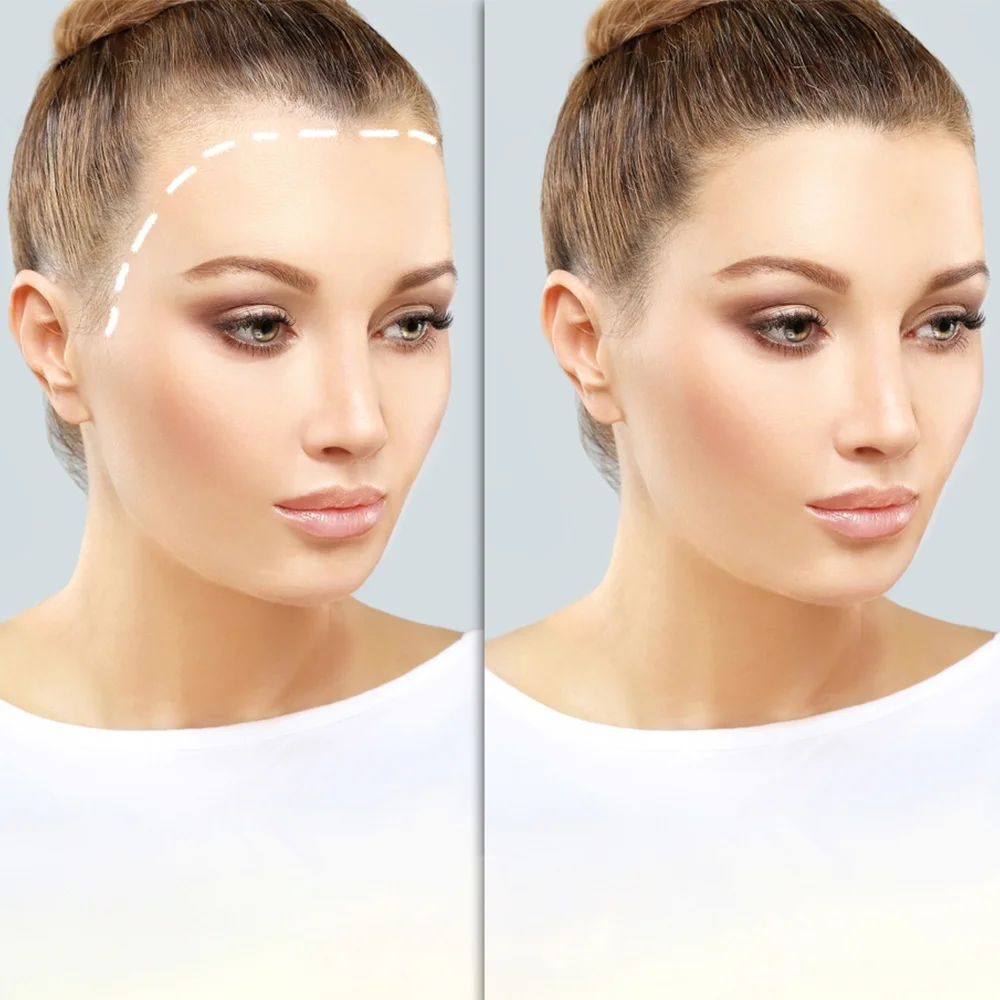 Hair Transplant – Real Results from Our Harley Street Clinic