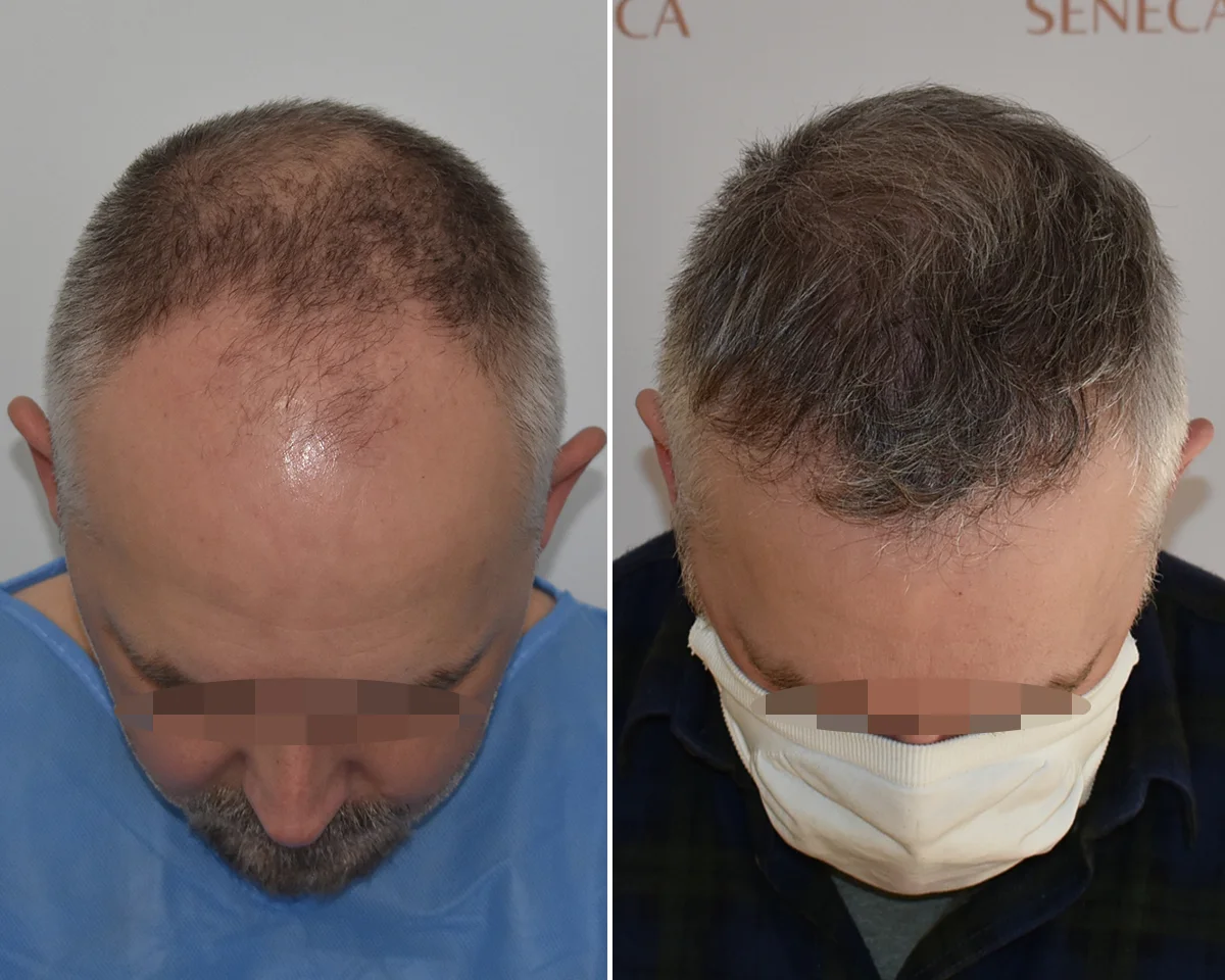 Best Hair Transplant UK Clinic – Discover Westminster Medical Group®
